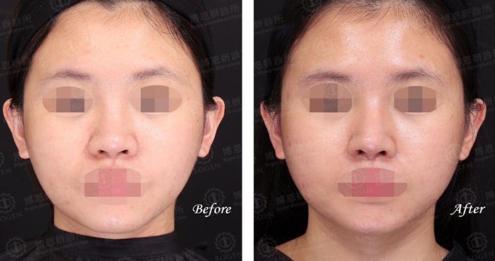 隆鼻術後口服A酸消腫更快,隆鼻與口服A酸,博恩妍